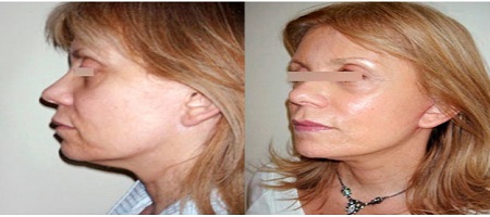 lifting visage prix pas cher