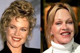 Photos avant après chirurgie plastique visage des stars Hollywood
