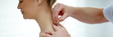 acupuncture contre la douleur