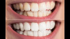 blanchir les dents pour obtenir hollywood smile