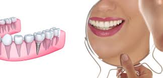 résultat implant dentaire Annemasse