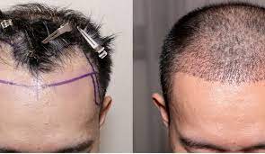 implant cheveux